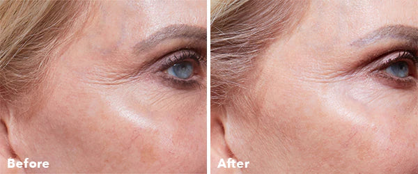 Home Microneedling Intro Kit