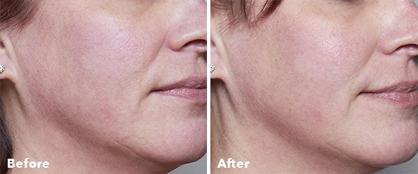 Home Microneedling Intro Kit