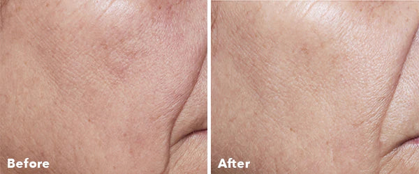 Home Microneedling Intro Kit